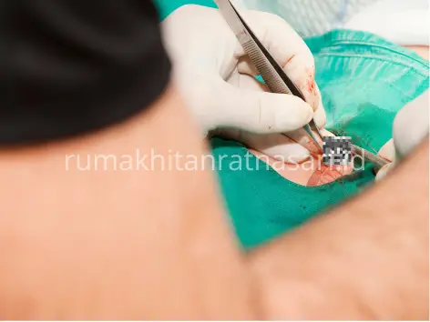Luka Sunat: Tips Ampuh Mempercepat Penyembuhan pada Anak